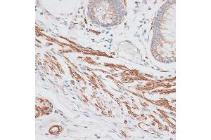 Immunohistochemistry of paraffin-embedded human colon carcinoma using GRK5 antibody (ABIN1680115, ABIN3018251, ABIN3018252 and ABIN6220413) at dilution of 1:100 (40x lens).