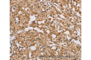 Immunohistochemistry of Human cervical cancer using DIDO1 Polyclonal Antibody at dilution of 1:50 (DIO1 anticorps)