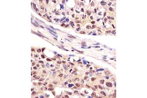 (ABIN1882188 and ABIN2839165) staining UCHL1 in human lung adenocarcinoma tissue sections by Immunohistochemistry (IHC-P - paraformaldehyde-fixed, paraffin-embedded sections).
