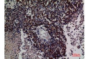 Immunohistochemistry (IHC) analysis of paraffin-embedded Human Lung Cancer, antibody was diluted at 1:100.
