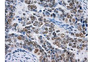 Immunohistochemical staining of paraffin-embedded Kidney tissue using anti-HNRNPFmouse monoclonal antibody.