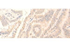 Immunohistochemistry of paraffin-embedded Human thyroid cancer tissue using ADGRE3 Polyclonal Antibody at dilution of 1:35(x200)