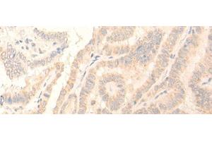 Immunohistochemistry of paraffin-embedded Human thyroid cancer tissue using ADGRE3 Polyclonal Antibody at dilution of 1:35(x200) (EMR3 anticorps)
