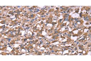 Immunohistochemistry of paraffin-embedded Human thyroid cancer tissue using SPAST Polyclonal Antibody at dilution 1:40 (Spastin anticorps)