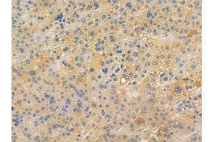 ABIN7096403 and ABIN7100467 at 1/100 staining human hepatocellular carcinoma by IHC-P. (TIMMDC1 anticorps)