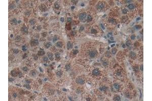 Detection of LTbR in Human Liver cancer Tissue using Polyclonal Antibody to Lymphotoxin Beta Receptor (LTbR)