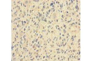 Immunohistochemistry of paraffin-embedded human glioma using ABIN7155411 at dilution of 1:100 (HIST1H2BN anticorps  (AA 2-126))
