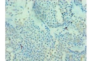 Immunohistochemistry of paraffin-embedded human breast cancer using ABIN7159680 at dilution of 1:100