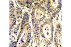 IHC analysis of FFPE human colon carcinoma stained with IGFBP6 antibody