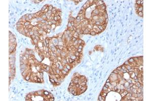 Formalin-fixed, paraffin-embedded human Colon Carcinoma stained with Cytokeratin 15 Mouse Monoclonal Antibody (KRT15/2957)