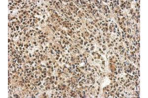 IHC-P Image Immunohistochemical analysis of paraffin-embedded AGS xenograft, using hnRNP 1, antibody at 1:500 dilution.