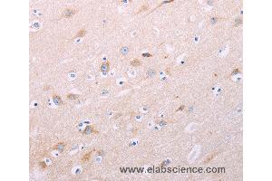 Immunohistochemistry of Human thyroid cancer using ADCY5 Polyclonal Antibody at dilution of 1:40 (ADCY5 anticorps)
