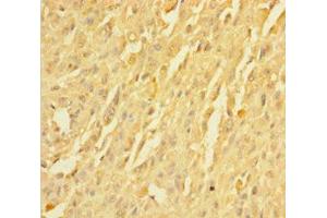 Immunohistochemistry of paraffin-embedded human melanoma using ABIN7173027 at dilution of 1:100