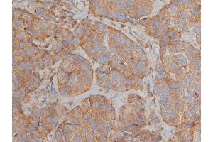 ABIN6268839 at 1/200 staining human breast cancer tissue sections by IHC-P.