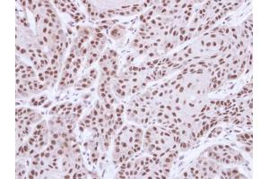 IHC-P Image Immunohistochemical analysis of paraffin-embedded Cal27 xenograft, using MST1, antibody at 1:500 dilution. (STK4 anticorps  (C-Term))