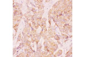 Anti-AAMP Picoband antibody,  IHC(P): Human Mammary Cancer Tissue (AAMP anticorps  (AA 235-434))