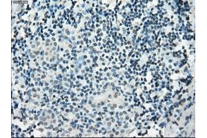 Immunohistochemical staining of paraffin-embedded Adenocarcinoma of colon tissue using anti-PDE10A mouse monoclonal antibody. (PDE10A anticorps)