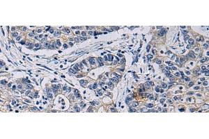 Immunohistochemistry of paraffin-embedded Human gastric cancer tissue using CHST3 Polyclonal Antibody at dilution of 1:35(x200) (CHST3 anticorps)