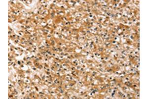 The image on the left is immunohistochemistry of paraffin-embedded Human prostate cancer tissue using ABIN7192485(SLC40A1 Antibody) at dilution 1/20, on the right is treated with synthetic peptide. (Band 3/AE1 anticorps)