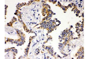 Anti- ATG14L Picoband antibody, IHC(P) IHC(P): Human Lung Cancer Tissue (ATG14 anticorps  (N-Term))