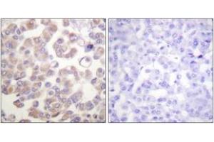 Immunohistochemistry analysis of paraffin-embedded human breast carcinoma tissue, using WNT1 Antibody. (WNT1 anticorps  (AA 301-350))