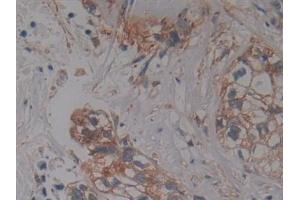 Detection of PKCi in Human Pancreatic cancer Tissue using Polyclonal Antibody to Protein Kinase C Iota (PKCi)