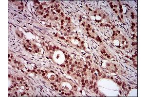Immunohistochemical analysis of paraffin-embedded cervical cancer tissues using NBN mouse mAb with DAB staining.