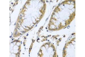 Immunohistochemistry of paraffin-embedded Human colon carcinoma using FBXL5 Polyclonal Antibody at dilution of 1:100 (40x lens). (FBXL5 anticorps)
