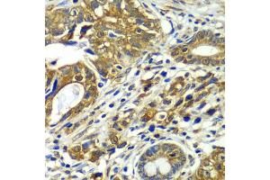 Immunohistochemistry of paraffin-embedded human gastric cancer using CDC16 antibody. (CDC16 anticorps)