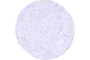 Paraganglioma lacking TH staining