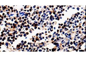 Immunohistochemistry of paraffin-embedded Human colon cancer tissue using ALOX5 Polyclonal Antibody at dilution 1:50 (ALOX5 anticorps)