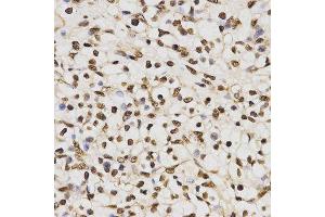 Immunohistochemistry of paraffin-embedded human kidney cancer tissue using H3R17me2a antibody at dilution of 1:200 (x400 lens)