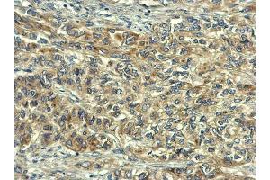 IHC-P Image RelB antibody detects RelB protein at cytoplasm on human lung cancer by immunohistochemical analysis.
