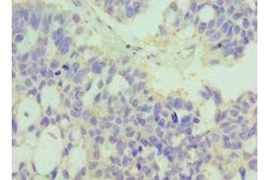Immunohistochemistry of paraffin-embedded human endometrial cancer using ABIN7174047 at dilution of 1:100 (MERTK anticorps  (AA 840-999))