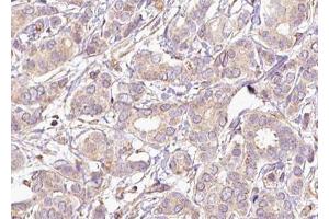 ABIN6267493 at 1/100 staining human breast carcinoma tissue sections by IHC-P. (MEK2 anticorps  (pThr394))