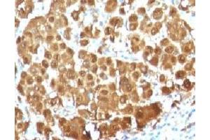 IHC testing of FFPE human melanoma with S100 beta antibody (clone S100B/1012). (S100B anticorps)