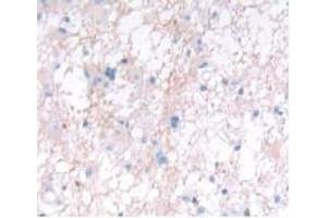 Detection of IFNa5 in Human Glioma Tissue using Monoclonal Antibody to Interferon Alpha 5 (IFNa5)