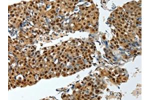 The image on the left is immunohistochemistry of paraffin-embedded Human breast cancer tissue using ABIN7193081(YBX1 Antibody) at dilution 1/15, on the right is treated with synthetic peptide. (YBX1 anticorps)
