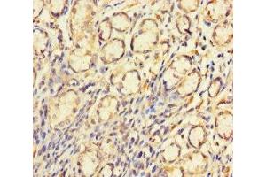 Immunohistochemistry of paraffin-embedded human gastric cancer using ABIN7148710 at dilution of 1:100