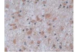 IHC-P analysis of Human Glioma Tissue, with DAB staining. (JAG2 anticorps  (AA 714-981))