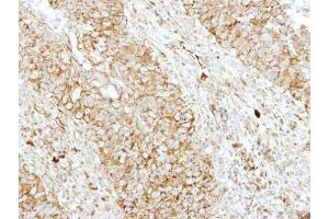 IHC-P Image Immunohistochemical analysis of paraffin-embedded human breast cancer, using EEN, antibody at 1:250 dilution. (SH3GL1 anticorps  (Center))