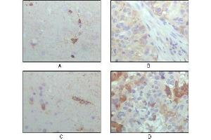 Immunohistochemical analysis of paraffin-embedded human brain hippocampus (A), lung cancer (B), brain tumor (C), breast cance (D), showing cytoplasmic localization with DAB staining using CRYAB antibody. (CRYAB anticorps  (AA 1-175))