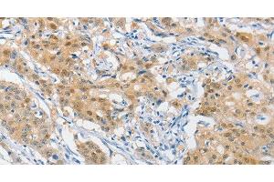 Immunohistochemistry of paraffin-embedded Human gastric cancer using HSP40 Polyclonal Antibody at dilution of 1:40