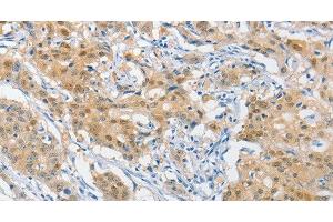 Immunohistochemistry of paraffin-embedded Human gastric cancer using HSP40 Polyclonal Antibody at dilution of 1:40 (DNAJB1 anticorps)