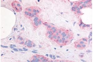 Human Breast Carcinoma (formalin-fixed, paraffin-embedded) stained with VEGFR2 antibody ABIN213631 at 10 ug/ml followed by biotinylated goat anti-rabbit IgG secondary antibody ABIN481713, alkaline phosphatase-streptavidin and chromogen. (VEGFR2/CD309 anticorps  (Internal Region))