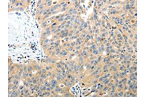 The image on the left is immunohistochemistry of paraffin-embedded Human ovarian cancer tissue using ABIN7130809(RAMP3 Antibody) at dilution 1/40, on the right is treated with fusion protein. (RAMP3 anticorps)