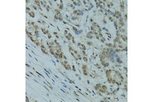 Immunohistochemistry of paraffin-embedded human colon carcinoma using GABPA antibody (ABIN6127940, ABIN6140889, ABIN6140892 and ABIN6224475) at dilution of 1:100 (40x lens).