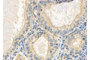 ABIN6264184 and ABIN6272389 at 1/100 staining Human ovarian cancer and adjacent normal tissues by IHC-P. (OLFML2B anticorps  (Internal Region))