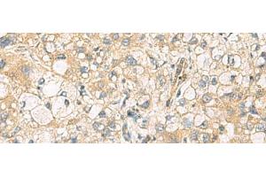 Immunohistochemistry of paraffin-embedded Human liver cancer tissue using DNAJA4 Polyclonal Antibody at dilution of 1:55(x200) (DNAJA4 anticorps)
