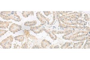 Immunohistochemistry of paraffin-embedded Human thyroid cancer tissue using EPRS Polyclonal Antibody at dilution of 1:60(x200)